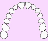 空隙歯列　すきっ歯