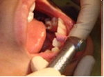 1.歯面の清掃