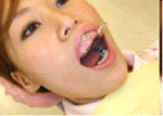 2.歯型の採取